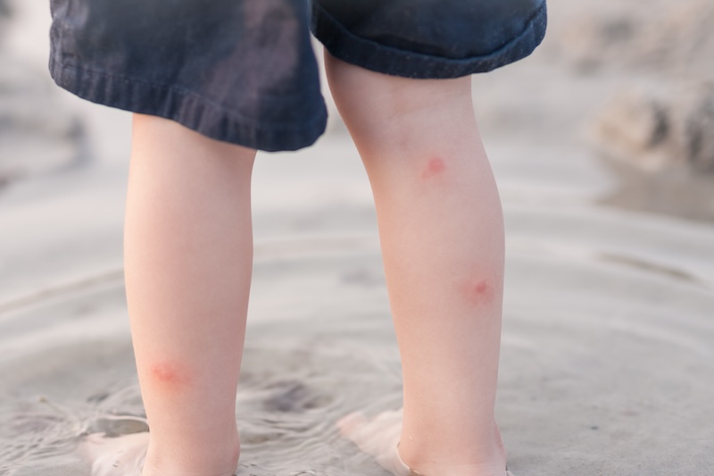 Chigger Control & Prevention | Abracadabra Lawn Pest Chigger Control & Prevention | Abracadabra Lawn Pest